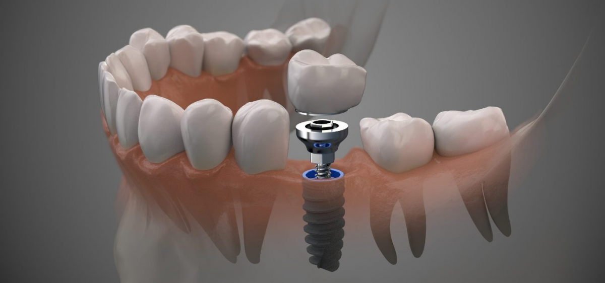 زراعة اسنان - دكتور اسنان محمد اكتورك - طرابزون - تركيا زراعة اسنان - دكتور اسنان محمد اكتورك - طرابزون - تركيا