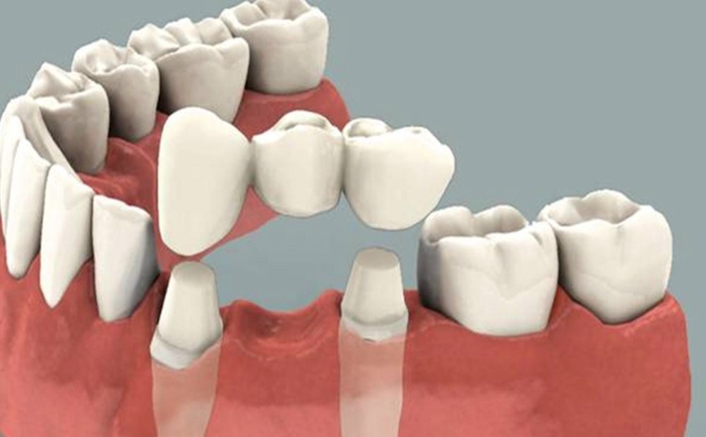 Porselen Diş - Diş Hekimi Muhammet Aktürk - Trabzon - Türkiye Porselen Diş - Diş Hekimi Muhammet Aktürk - Trabzon - Türkiye