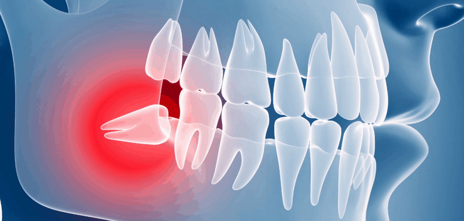 Wisdom Teeth Removal - Muhammet Akturk - Dentist - Trabzon - Turkey Wisdom Teeth Removal - Muhammet Akturk - Dentist - Trabzon - Turkey