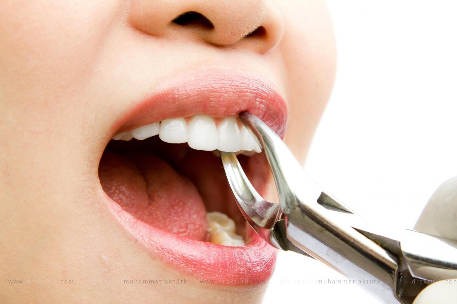 Tooth Extraction - Muhammet Akturk - Dentist - Trabzon - Turkey Tooth Extraction - Muhammet Akturk - Dentist - Trabzon - Turkey