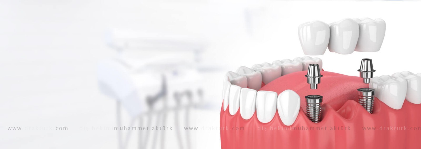 زراعة اسنان - دكتور اسنان محمد اكتورك - طرابزون - تركيا زراعة اسنان - دكتور اسنان محمد اكتورك - طرابزون - تركيا
