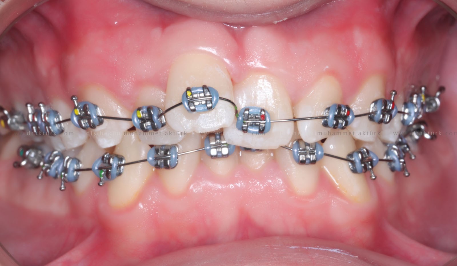 Muhammet Akturk - Dentist - Trabzon - Turkey Muhammet Akturk - Dentist - Trabzon - Turkey