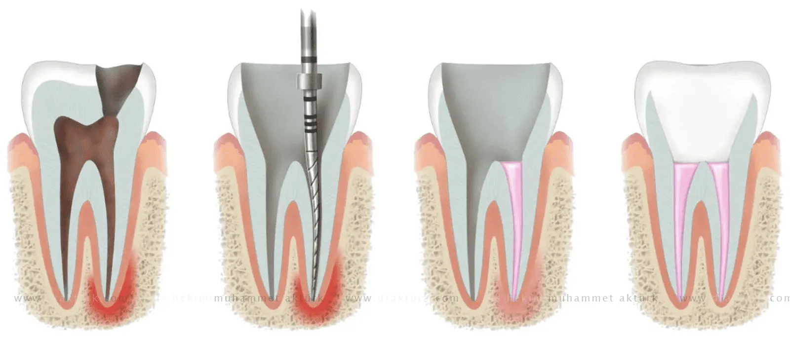 Root Canal Therapy - Dentist Muhammet Akturk - Trabzon - Turkey Root Canal Therapy - Dentist Muhammet Akturk - Trabzon - Turkey