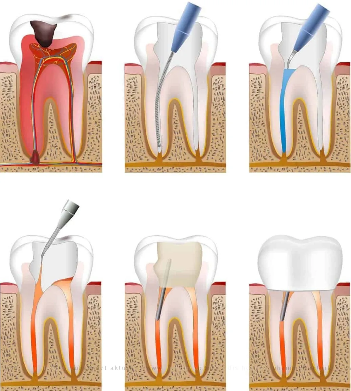 Root Canal Therapy - Dentist Muhammet Akturk - Trabzon - Turkey Root Canal Therapy - Dentist Muhammet Akturk - Trabzon - Turkey