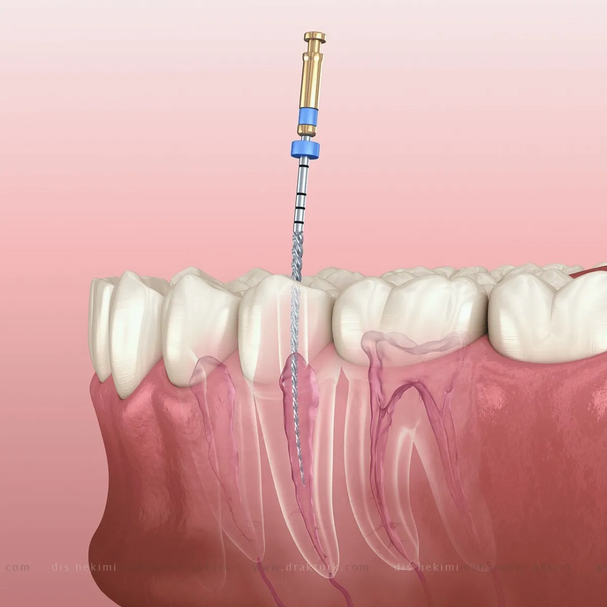 Root Canal Therapy - Dentist Muhammet Akturk - Trabzon - Turkey Root Canal Therapy - Dentist Muhammet Akturk - Trabzon - Turkey