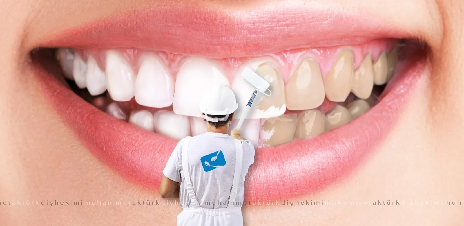Teeth Whitening - Dentist Muhammet Aktürk - Trabzon - Turkey Teeth Whitening - Dentist Muhammet Aktürk - Trabzon - Turkey