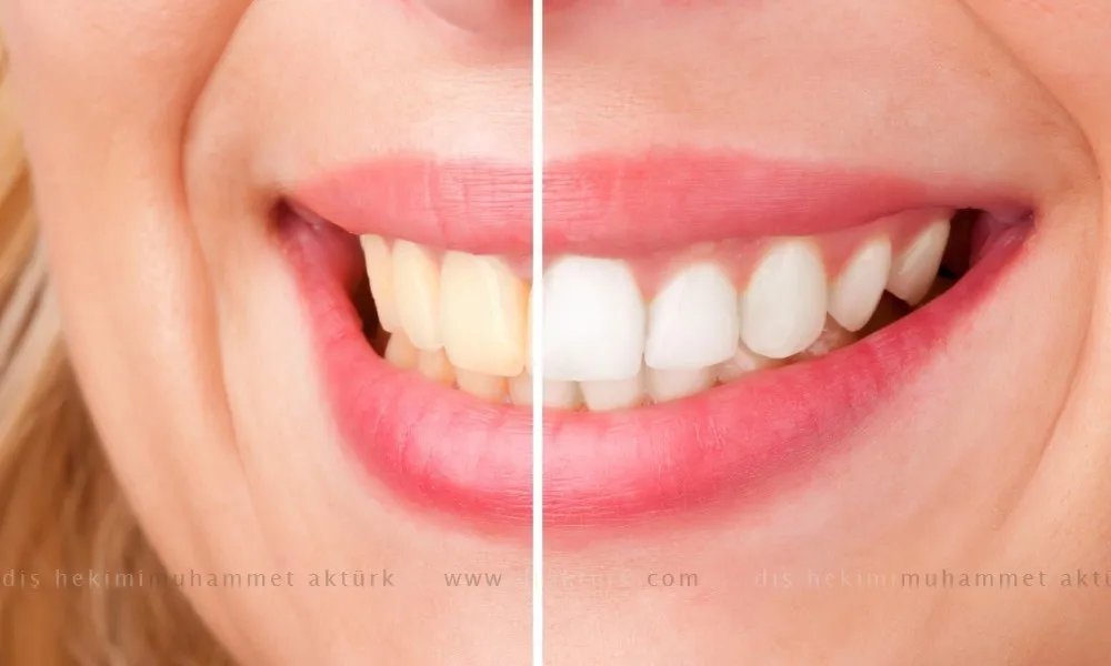 Teeth Whitening - Dentist Muhammet Akturk - Trabzon - Turkey Teeth Whitening - Dentist Muhammet Akturk - Trabzon - Turkey