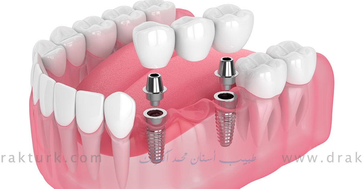 طبيب اسنان محمد اكتورك - طرابزون - تركيا طبيب اسنان محمد اكتورك - طرابزون - تركيا